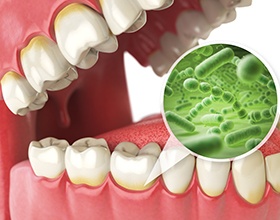 An image highlighting bacteria around the teeth and gums