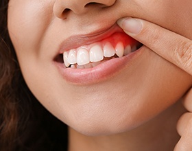 A woman with inflamed gums