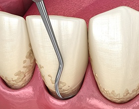 A 3D illustration of scaling and root planing