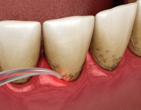 A 3D illustration of a laser periodontal treatment