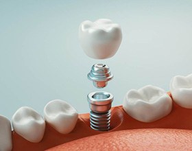 A 3D illustration of a single dental implant