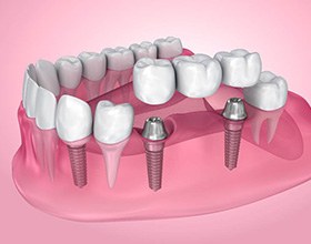 A 3D illustration of a dental implant bridge