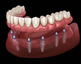 A 3D illustration of an implant denture