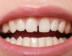 Front teeth with gap between them?