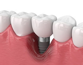 Illustration of gum recession around failed dental implant in Chesterfield, MO