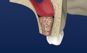 Model of bone grafting for a dental implant